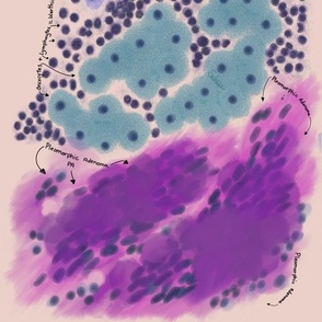 pleomorphic adenoma
Cells from the human body prints are also available. 
Cytology,  pathology,  histology,  teaching and learning guide.  Use it on any science project.  
Other cell types are in the shop and in our site CytoNerd.com 