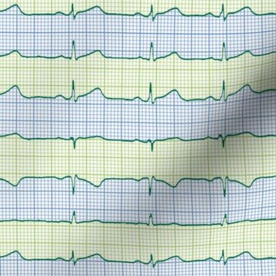 EKG:  a chevron from the heart
