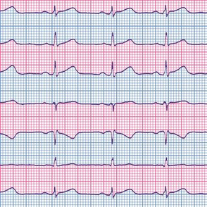 EKG:  a chevron from the heart (pink)