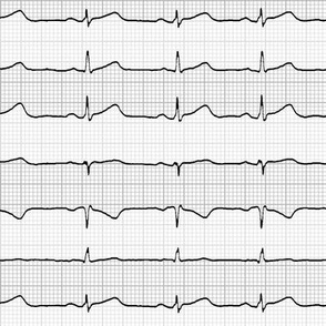 EKG:  a chevron from the heart (grey)