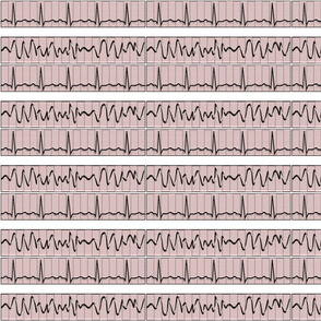 EKG Strips